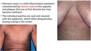 • Pityriasis rosea is a mild inflammatory exanthem
characterized by salmon-colored thin papules
and plaques that are at first discrete but may
become confluent
• The individual patches are oval and covered
with dry epidermis, which often desquamates,
leaving scaling in the center.
 