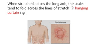 When stretched across the long axis, the scales
tend to fold across the lines of stretch  hanging
curtain sign
 