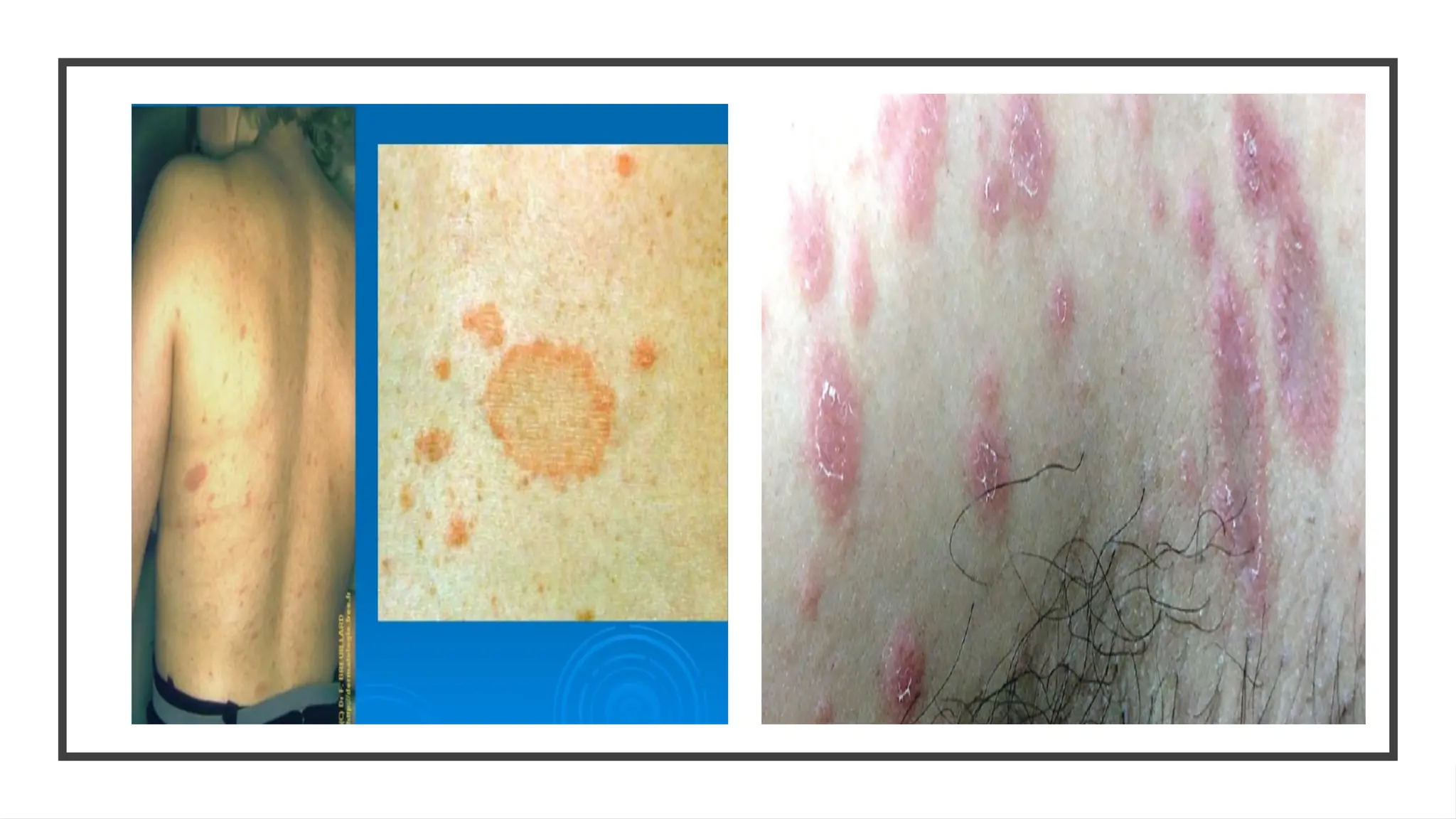 Rosette Rash Pityriasis rosea dermatology small lecture.pptx