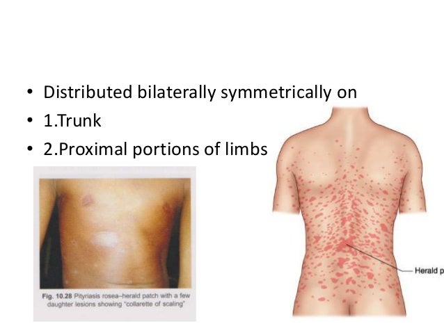 pityriasis rosea lichenoides rash shaped like christmas tree