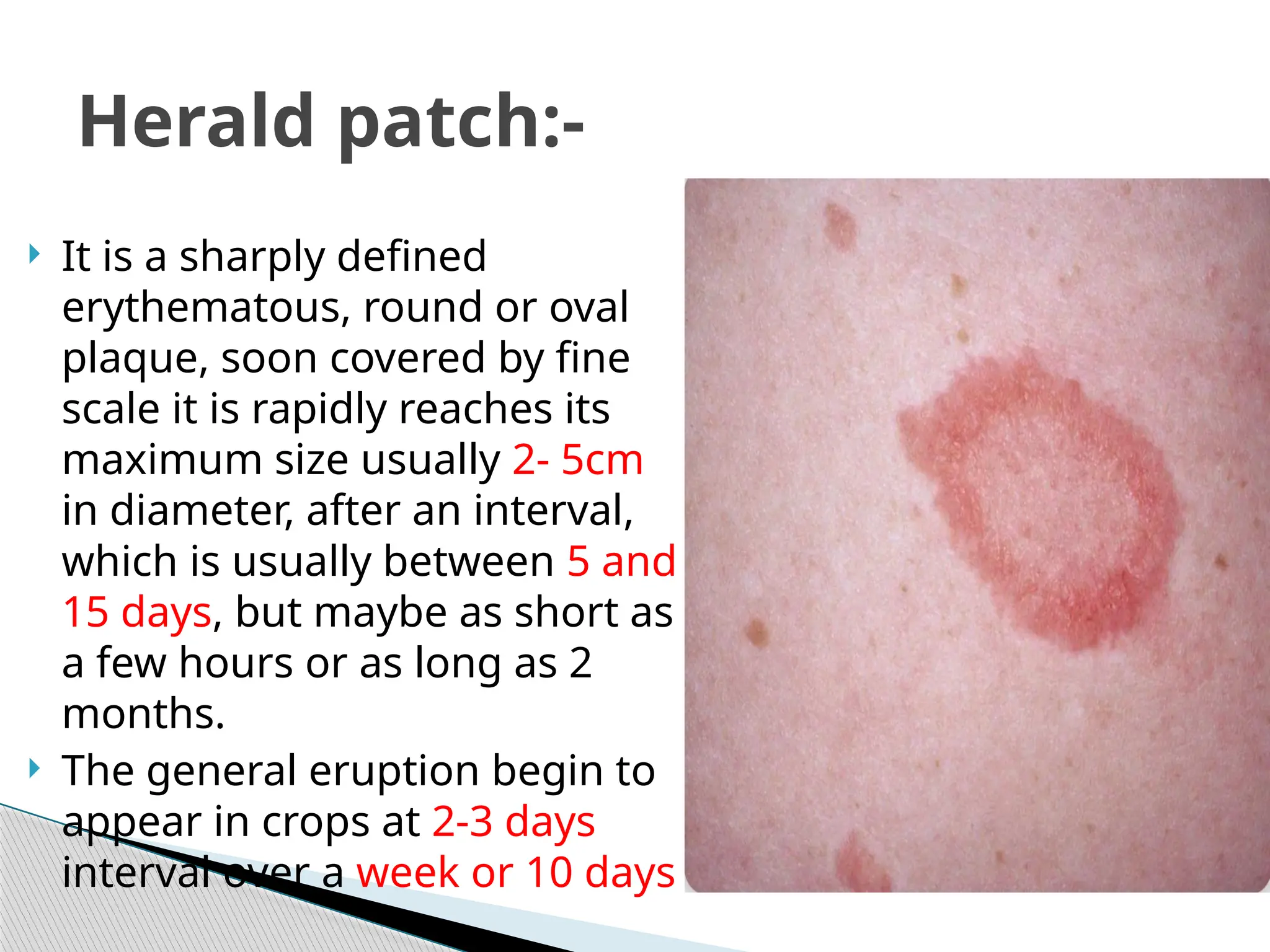 Ovoid Rash Pityriasis Rosea in dermatology and it's management | PPTX