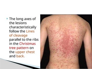 Pityriasis Rosea in dermatology and it's management | PPTX