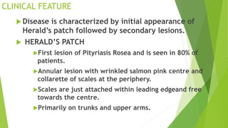 Pityriasis versicolor | PPTX
