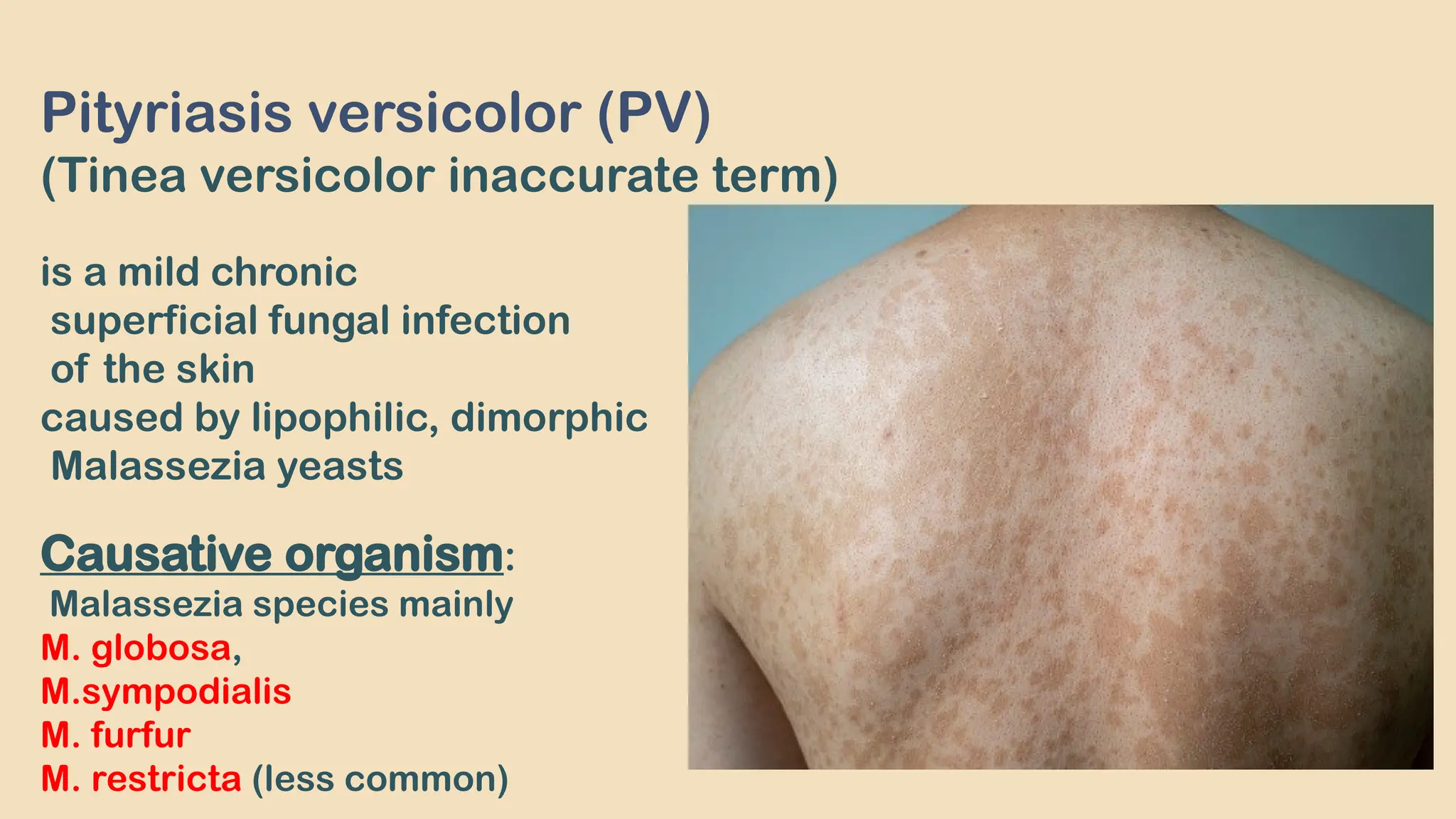 Skin Infection Color Pityriasis versicolor superficial fungal skin infection .pptx
