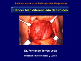 Instituto Nacional de Enfermedades Neoplásicas
Dr. Fernando Torres Vega
Departamento de Cabeza y Cuello
Cáncer bien diferenciado de tiroides
 