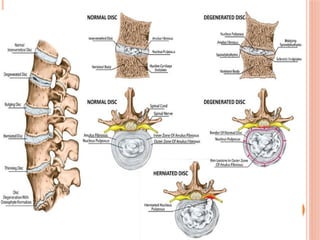 prolapsed intervertebral disc presentation | PPTX
