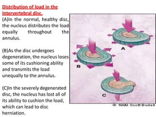 Distribution of load in the
Intervertebral disc.
(A)In the normal, healthy disc,
the nucleus distributes the load
equally throughout the
annulus.
(B)As the disc undergoes
degeneration, the nucleus loses
some of its cushioning ability
and transmits the load
unequally to the annulus.
(C)In the severely degenerated
disc, the nucleus has lost all of
its ability to cushion the load,
which can lead to disc
herniation.
 