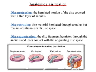 Anatomic classification
Disc protrusion: the herniated portion of the disc covered
with a thin layer of annulus
Disc extrusion: disc material herniated through annulus but
remains continuous with disc space
Disc sequestration: the disc fragment herniates through the
annulus and loses contact with the originating disc space
 