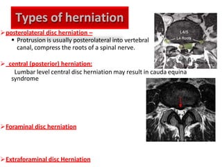 posterolateral disc herniation –
 Protrusion is usually posterolateral into vertebral
canal, compress the roots of a spinal nerve.
 central (posterior) herniation:
Lumbar level central disc herniation may result in cauda equina
syndrome
Foraminal disc herniation
Extraforaminal disc Herniation
Types of herniation
 
