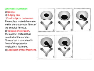Schematic illustration
a) Normal
b) Bulging disk
c)Focal bulge or protrusion.
The nucleus material remains
within the outermost fibres of
the annulus fibrosus.
d)Prolapse or extrusion.
The nucleus material has
penetrated the annulus
fibrosus but is contained in
front of the posterior
longitudinal ligament.
e) Sequester or free fragment.
 