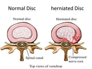 Normal Disc herniated Disc
 