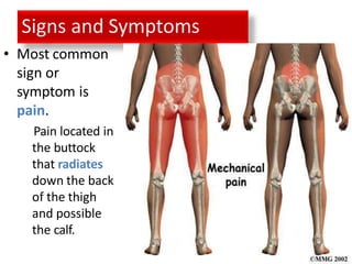Signs and Symptoms
• Most common
sign or
symptom is
pain.
Pain located in
the buttock
that radiates
down the back
of the thigh
and possible
the calf.
 