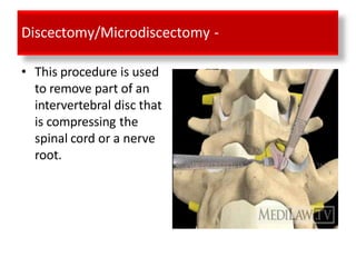 Discectomy/Microdiscectomy -
• This procedure is used
to remove part of an
intervertebral disc that
is compressing the
spinal cord or a nerve
root.
 