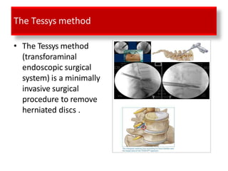 The Tessys method
• The Tessys method
(transforaminal
endoscopic surgical
system) is a minimally
invasive surgical
procedure to remove
herniated discs .
 