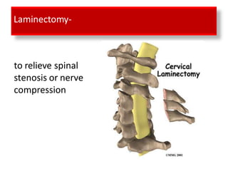 Laminectomy-
to relieve spinal
stenosis or nerve
compression
 