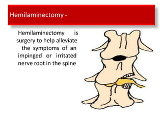 Hemilaminectomy -
Hemilaminectomy is
surgery to help alleviate
the symptoms of an
impinged or irritated
nerve root in the spine
 