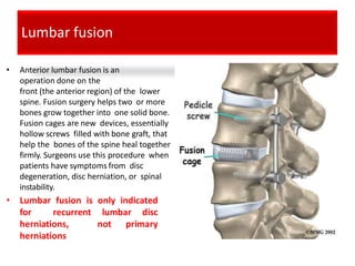 Lumbar fusion
• Anterior lumbar fusion is an
operation done on the
front (the anterior region) of the lower
spine. Fusion surgery helps two or more
bones grow together into one solid bone.
Fusion cages are new devices, essentially
hollow screws filled with bone graft, that
help the bones of the spine heal together
firmly. Surgeons use this procedure when
patients have symptoms from disc
degeneration, disc herniation, or spinal
instability.
• Lumbar fusion is only indicated
for recurrent lumbar disc
herniations, not primary
herniations
 