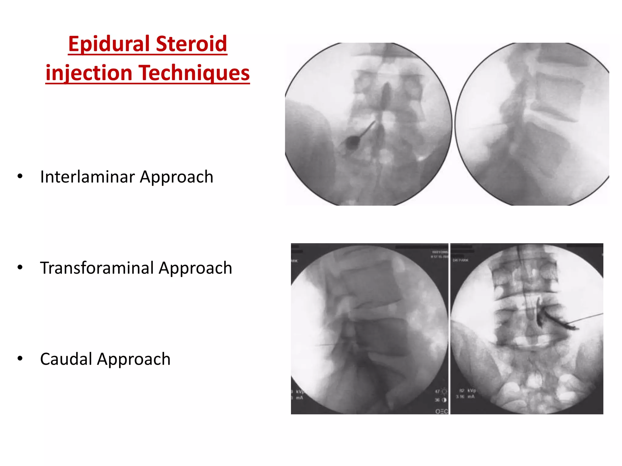 Pirolead Inj INTERVERTEBRAL DISC ANATOMY AND PIVD OF LUMBAR SPINE AND ITS MANAGEMENT ...