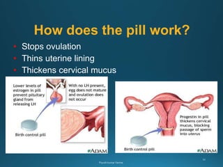 How does the pill work?
• Stops ovulation
• Thins uterine lining
• Thickens cervical mucus
 