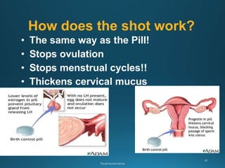 How does the shot work?
• The same way as the Pill!
• Stops ovulation
• Stops menstrual cycles!!
• Thickens cervical mucus
 