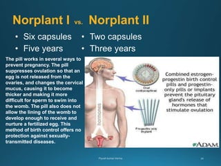 Norplant I vs. Norplant II
• Six capsules
• Five years
• Two capsules
• Three years
The pill works in several ways to
prevent pregnancy. The pill
suppresses ovulation so that an
egg is not released from the
ovaries, and changes the cervical
mucus, causing it to become
thicker and making it more
difficult for sperm to swim into
the womb. The pill also does not
allow the lining of the womb to
develop enough to receive and
nurture a fertilized egg. This
method of birth control offers no
protection against sexually-
transmitted diseases.
 