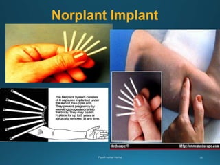 Norplant Implant
 