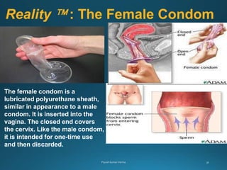 Reality  : The Female Condom
The female condom is a
lubricated polyurethane sheath,
similar in appearance to a male
condom. It is inserted into the
vagina. The closed end covers
the cervix. Like the male condom,
it is intended for one-time use
and then discarded.
 