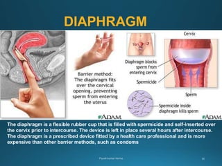 DIAPHRAGM
The diaphragm is a flexible rubber cup that is filled with spermicide and self-inserted over
the cervix prior to intercourse. The device is left in place several hours after intercourse.
The diaphragm is a prescribed device fitted by a health care professional and is more
expensive than other barrier methods, such as condoms
 