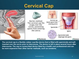 Cervical Cap
The cervical cap is a flexible rubber cup-like device that is filled with spermicide and self-
inserted over the cervix prior to intercourse. The device is left in place several hours after
intercourse. The cap is a prescribed device fitted by a health care professional and can
be more expensive than other barrier methods, such as condoms.
 