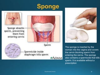 Sponge
The sponge is inserted by the
woman into the vagina and covers
the cervix blocking sperm from
entering the cervix. The sponge
also contains a spermicide that kills
sperm. It is available without a
prescription
 
