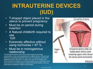 INTRAUTERINE DEVICES
(IUD)
• T-shaped object placed in the
uterus to prevent pregnancy
• Must be on period during
insertion
• A Natural childbirth required to
use
IUD
• Extremely effective without
using hormones > 97 %
• Must be in monogamous
relationship
The intrauterine device (IUD) shown uses copper as the active
contraceptive, others use progesterone in a plastic device. IUDs are very
effective at preventing pregnancy (less than 2% chance per year for the
progesterone IUD, less than 1% chance per year for the copper IUD).
IUDs come with increased risk of ectopic pregnancy and perforation of the
uterus and do not protect against sexually transmitted disease. IUDs are
prescribed and placed by health care providers.
 