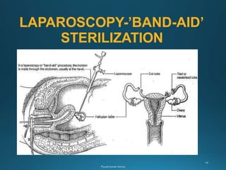 LAPAROSCOPY-’BAND-AID’
STERILIZATION
 