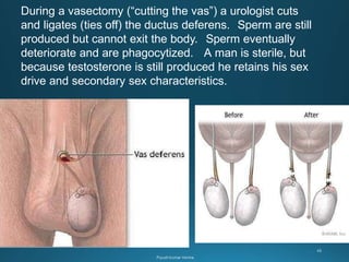 During a vasectomy (“cutting the vas”) a urologist cuts
and ligates (ties off) the ductus deferens. Sperm are still
produced but cannot exit the body. Sperm eventually
deteriorate and are phagocytized. A man is sterile, but
because testosterone is still produced he retains his sex
drive and secondary sex characteristics.
 