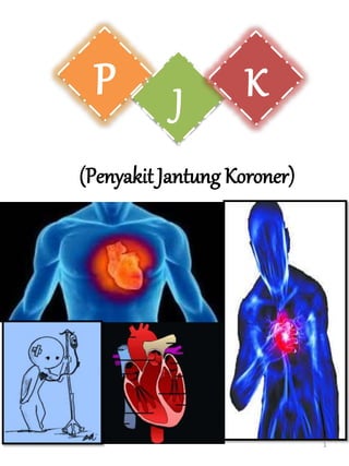 (Penyakit Jantung Koroner)
P J K
1
 