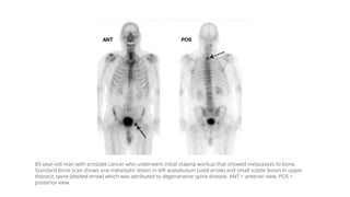 85-year-old man with prostate cancer who underwent initial staging workup that showed metastases to bone.
Standard bone sc...