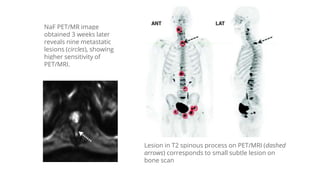 NaF PET/MR image
obtained 3 weeks later
reveals nine metastatic
lesions (circles), showing
higher sensitivity of
PET/MRI.
...