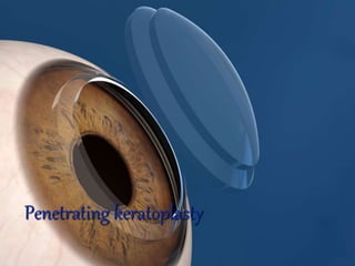 DR SHIMNA
Penetrating keratoplasty
Penetrating keratoplasty
 