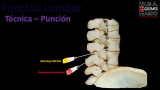 Punción Lumbar EMERGENTOLOGÍA
Técnica – Punción
Abordaje Medial
Abordaje Paramedial
 