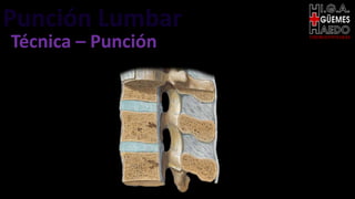 Punción Lumbar EMERGENTOLOGÍA
Técnica – Punción
 