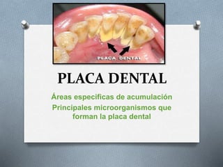 PLACA DENTAL
Áreas especificas de acumulación
Principales microorganismos que
forman la placa dental
 