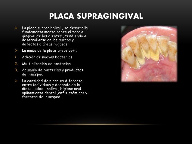 Placa dental (biofilm)