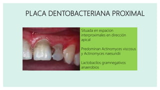 PLACA DENTOBACTERIANA PROXIMAL
Situada en espacion
interproximales en dirección
apical
Predominan Actinomyces viscosus
y Actinomyces naesundii
Lactobacilos gramnegativos
anaerobios
 