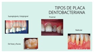 Supragingival y Subgingival
TIPOS DE PLACA
DENTOBACTERIANA
Proximal
De fosas y fisuras
Radicular
 
