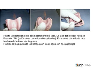 Repita la operación en la zona posterior de la laca. La laca debe llegar hasta la
línea del “Ah” (unión zona posterior tuberosidades). En la zona posterior la laca
también debe tener doble grosor.
Finalice la laca puliendo los bordes con lija al agua (sin adelgazarlos)
 