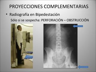 PROYECCIONES COMPLEMENTARIAS
• Radiografía en Bipedestación
Sólo si se sospecha: PERFORACIÓN – OBSTRUCCIÓN
 