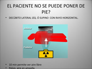 EL PACIENTE NO SE PUEDE PONER DE
PIE?
• DECÚBITO LATERAL IZQ. Ó SUPINO CON RAYO HORIZONTAL.
• 10 min permite ver aire libre
• Pelvis: aire en ampolla
 