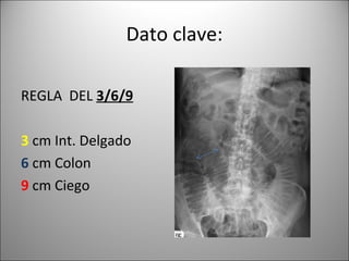 Dato clave:
REGLA DEL 3/6/9
3 cm Int. Delgado
6 cm Colon
9 cm Ciego
 