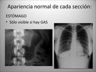 Apariencia normal de cada sección:
ESTÓMAGO
• Sólo visible si hay GAS
 