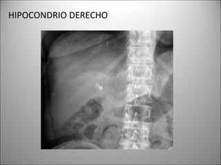 HIPOCONDRIO DERECHO
 
