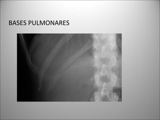 BASES PULMONARES
 